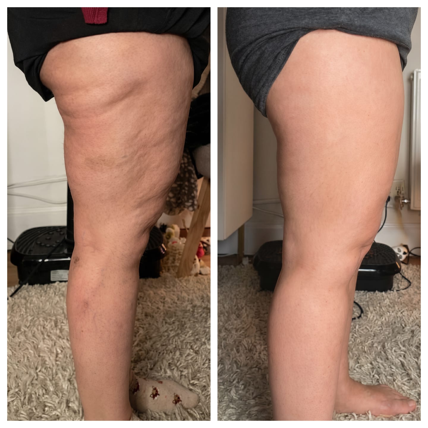 Before and after thigh result