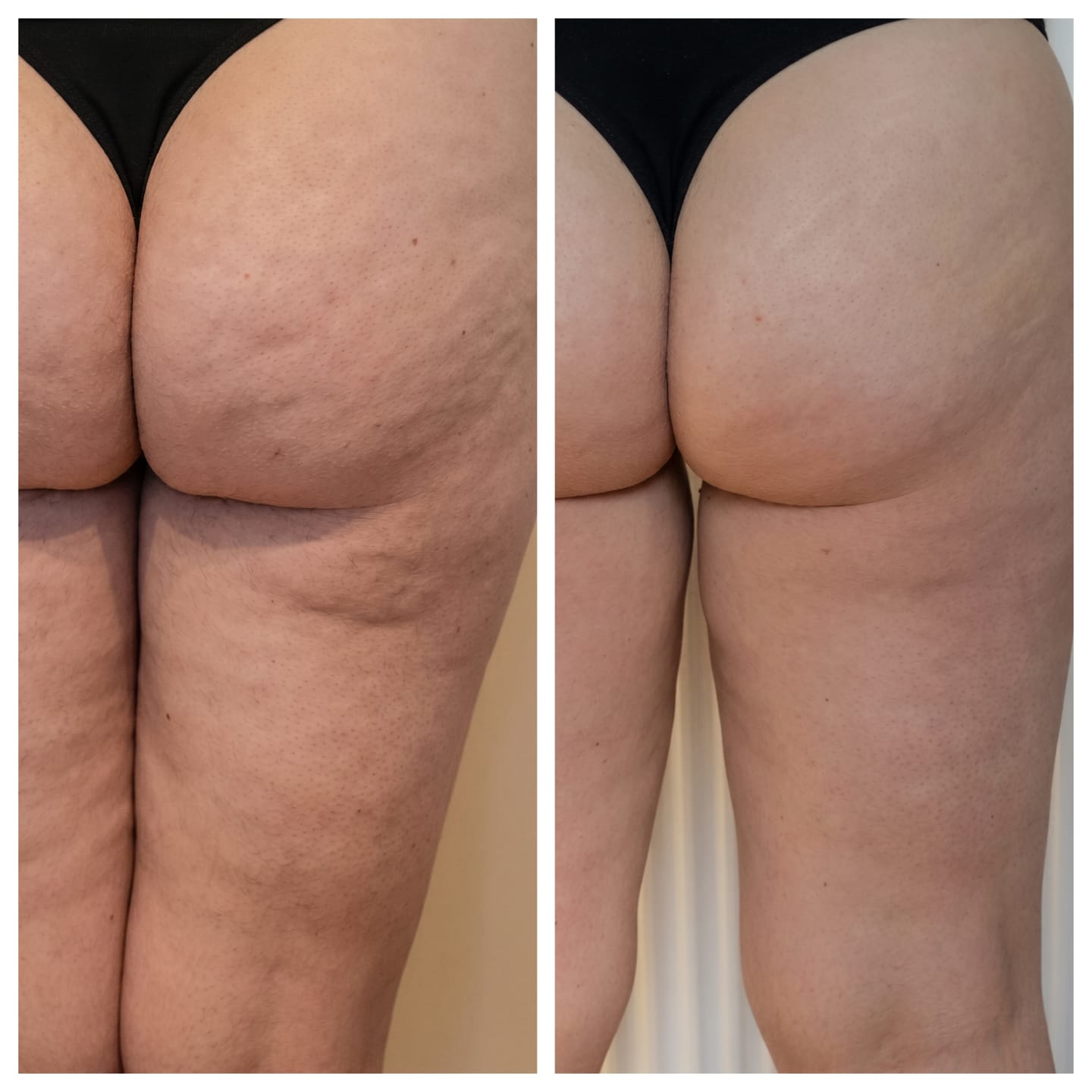 Before and after cellulite result