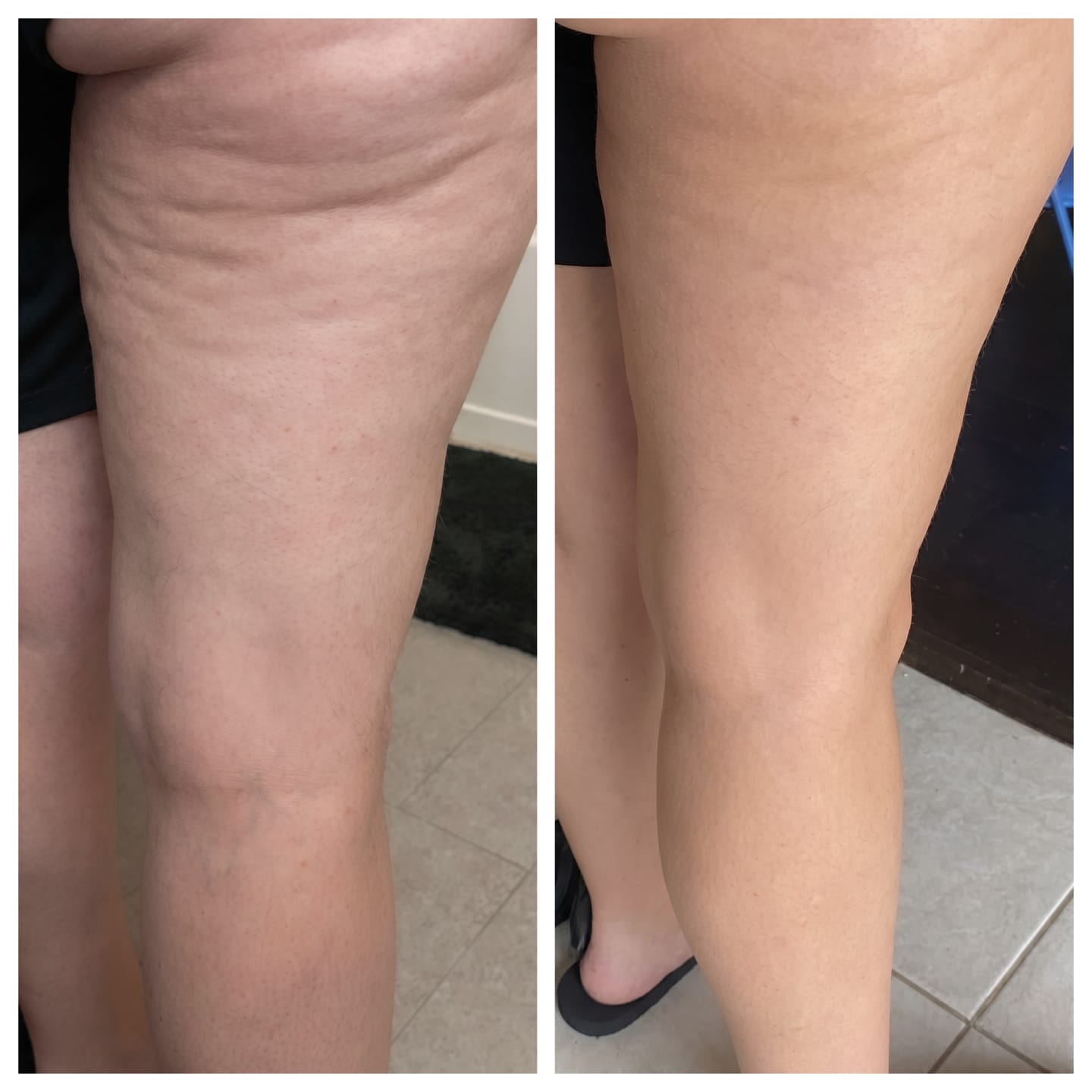 Before and after leg smoothing result