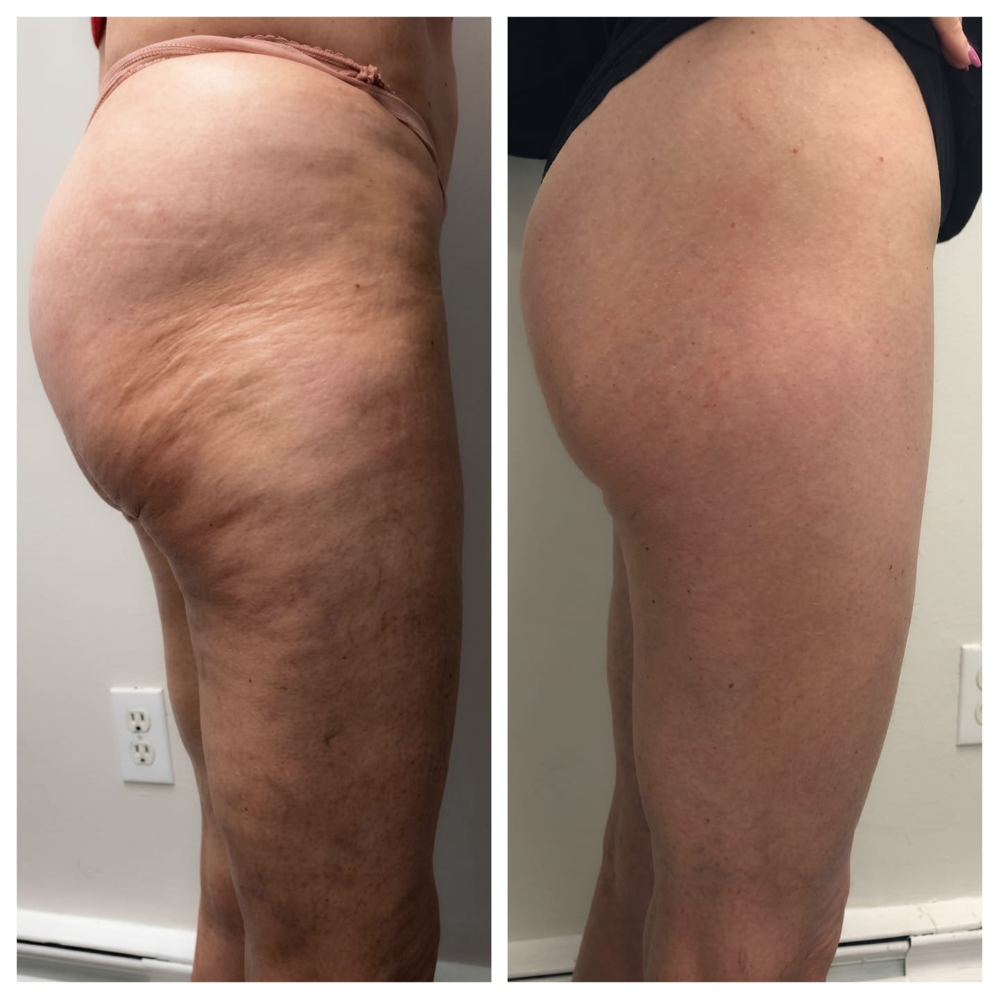 Before and after leg result
